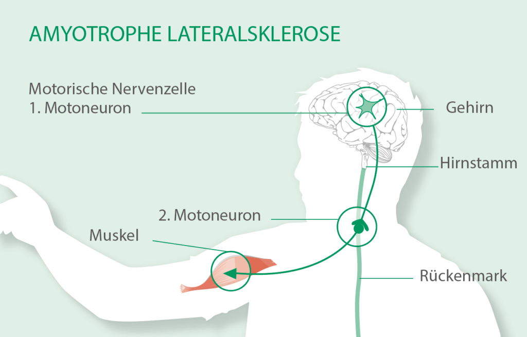 Symptome und Verlauf - Leben mit ALS
